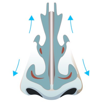 deviated nose rhinoplasty korea