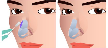 hump nose rhinoplasty korea