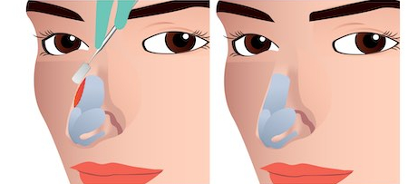 hump nose rhinoplasty korea