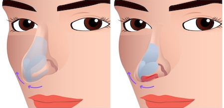 long nose rhinoplasty korea