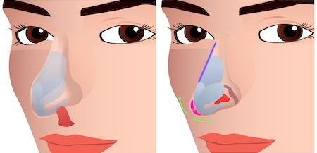 long nose rhinoplasty korea