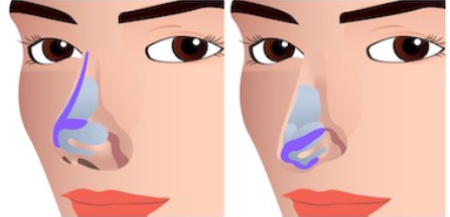 short nose rhinoplasty korea