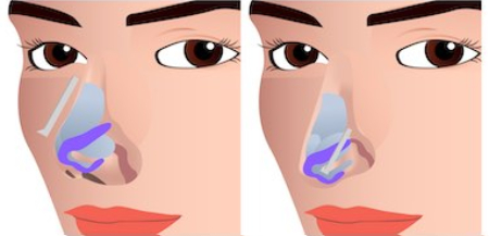 short nose rhinoplasty korea