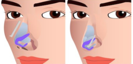 short nose rhinoplasty korea