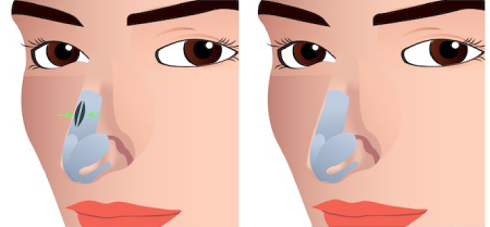 wide nose rhinoplasty korea