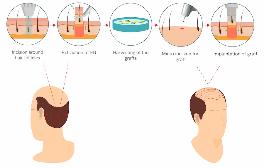 hair transplant korea fue