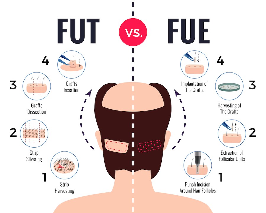 hair transplant fue vs fut in korea