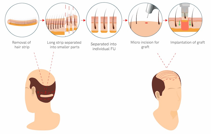 hair transplant korea fut